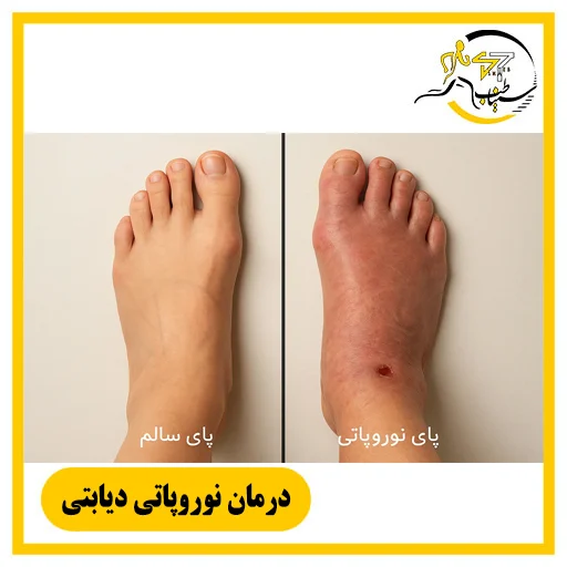 درمان نوروپاتی دیابتی در شیراز