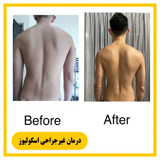 درمان اسکولیوز در شیراز با تکنیک شروت، تمرینات اصلاحی و بریس اختصاصی. کلینیک سیناطب، برنامهای شخصیسازیشده و غیرجراحی ارائه میدهد.